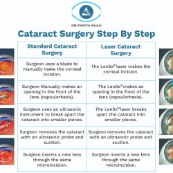 Difference between standard cataract surgery and laser cataract surgery